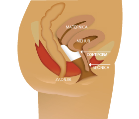 Kako deluje Contiform