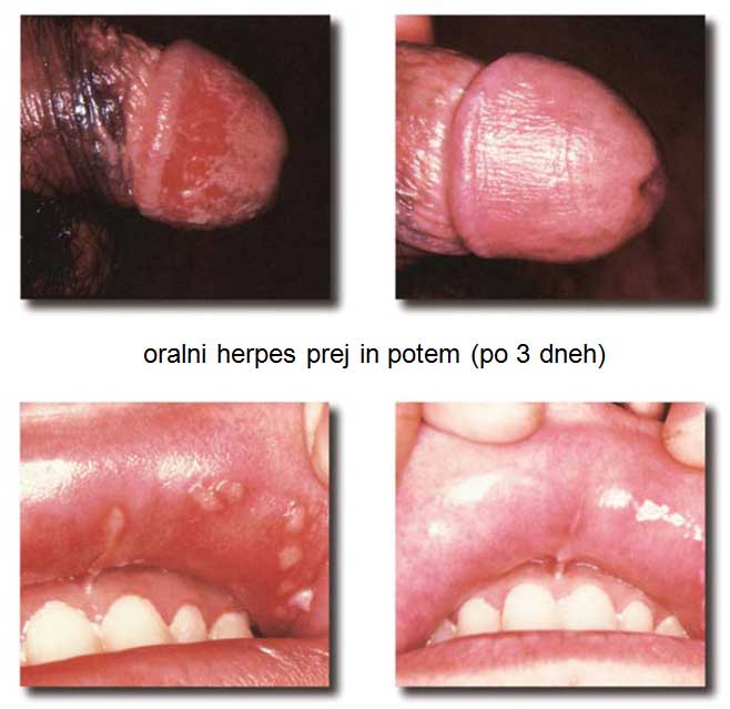 Genitalni herpes genitalni herpes