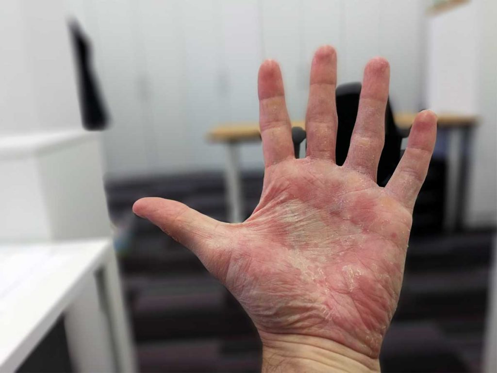 simptomi na roki dermatitis
