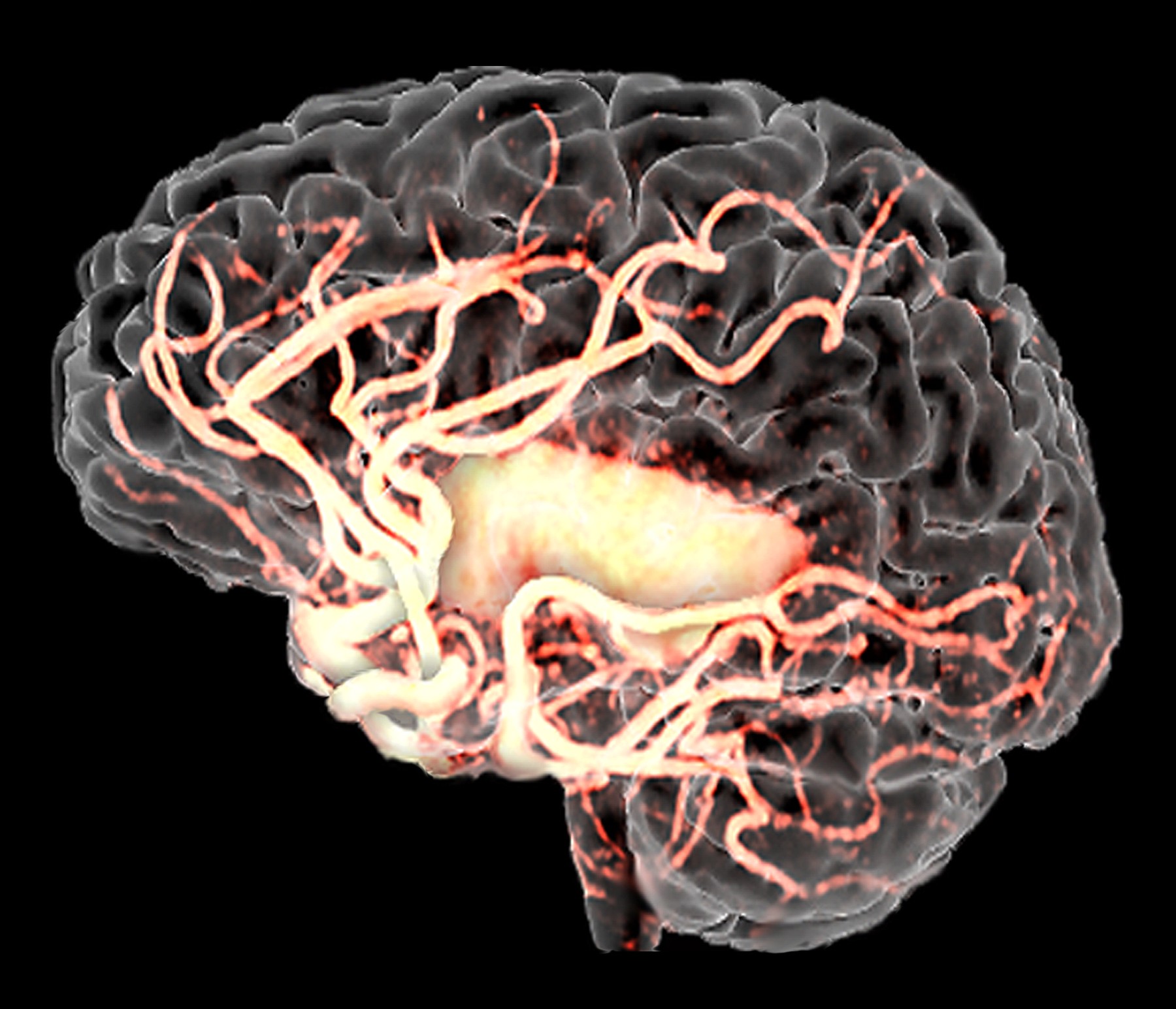 Ангиодистония сосудов. Ангиодистония церебральных сосудов. Ангиодистония сосудов головного мозга что это такое. МРА сосудов головного мозга. Кт головы и сосудов головного мозга.