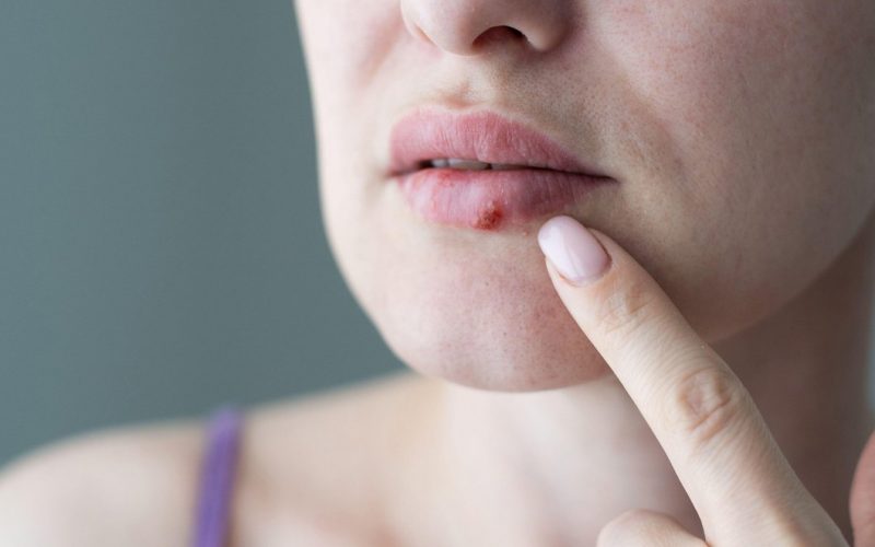 Slovenska infektologinja: nikoli ne počnite tega, če imate na ustnicah herpes!