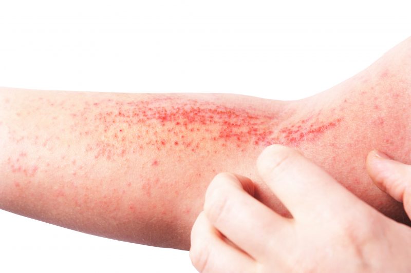 Bi Prepoznali Dermatitis Med Over Net