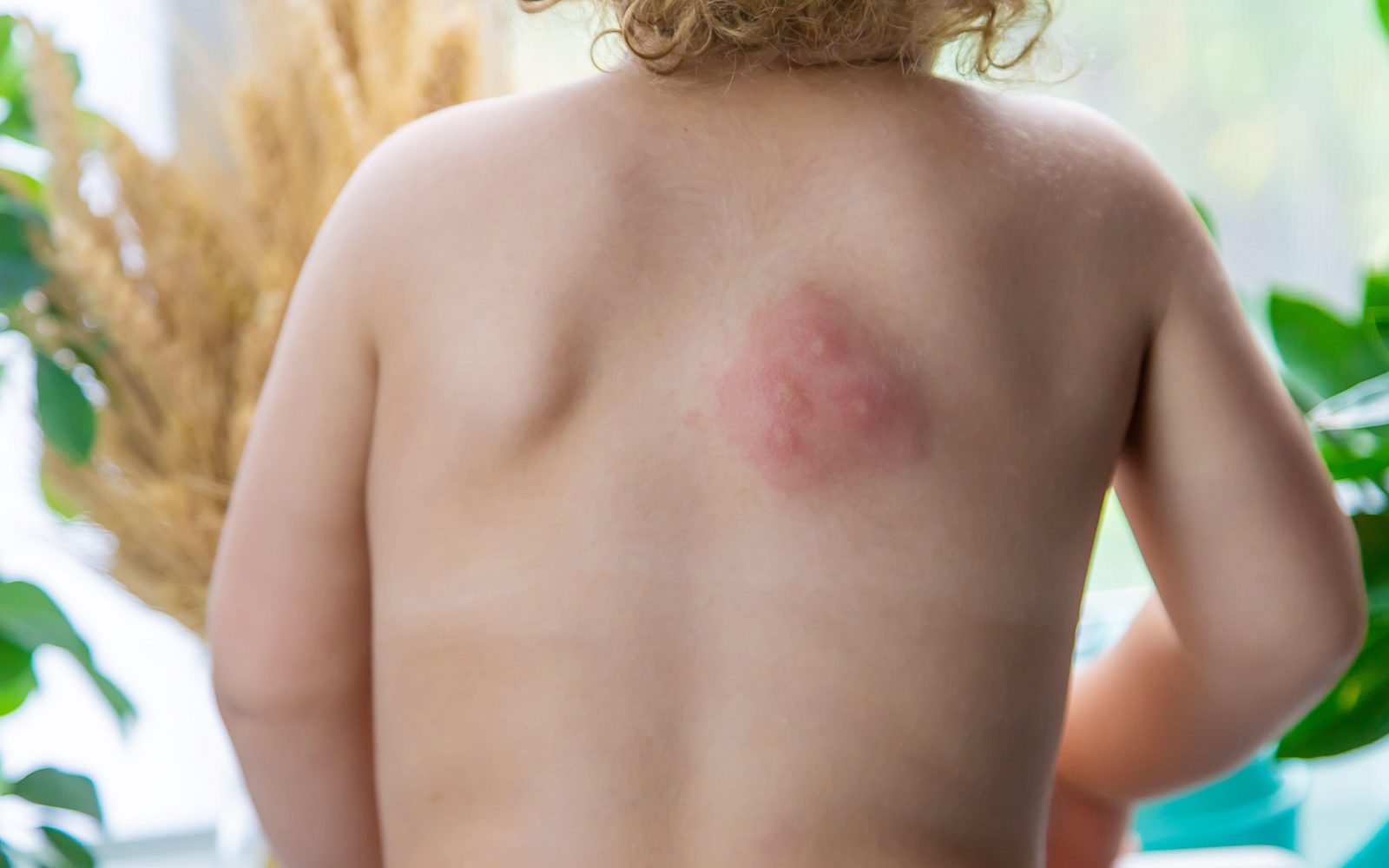 Popikan otroški hrbet z blago alergijsko reakcijo