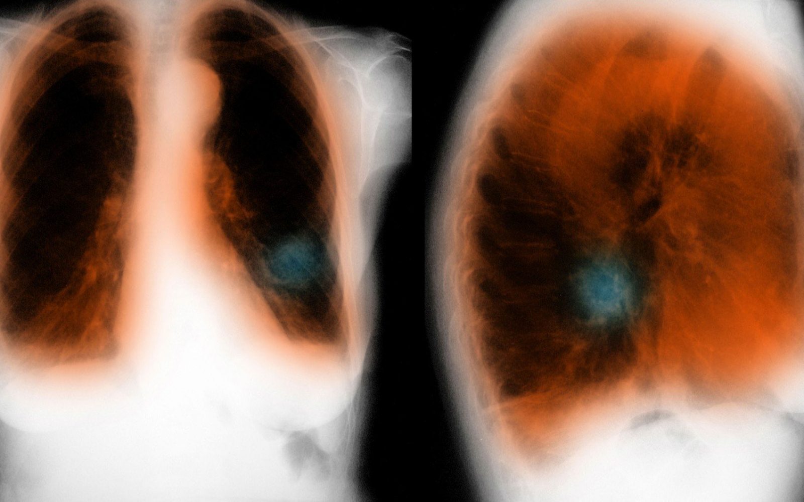 Bolezen je zahrbtna, pozno diagnosticirana in neozdravljiva