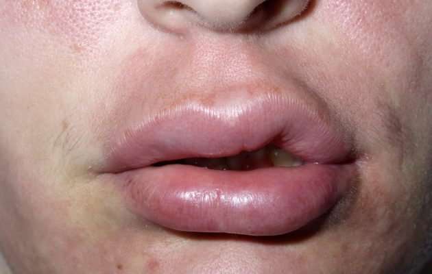 zatečena usta zaradi alergija, na sliki je ženksa.