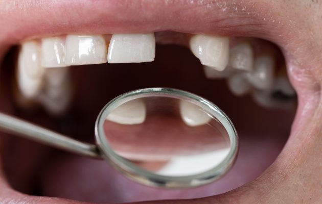 Makro fotografija prikazuje zobozdravniški pregled ustne votline. Zobozdravniško ogledalo odraža stanje zob in dlesni, kar poudarja pomembnost rednih zobozdravniških pregledov za ohranjanje ustnega zdravja. Slika je idealna za članke o zobozdravstveni negi, preventivnih pregledih in skrbi za zobe.