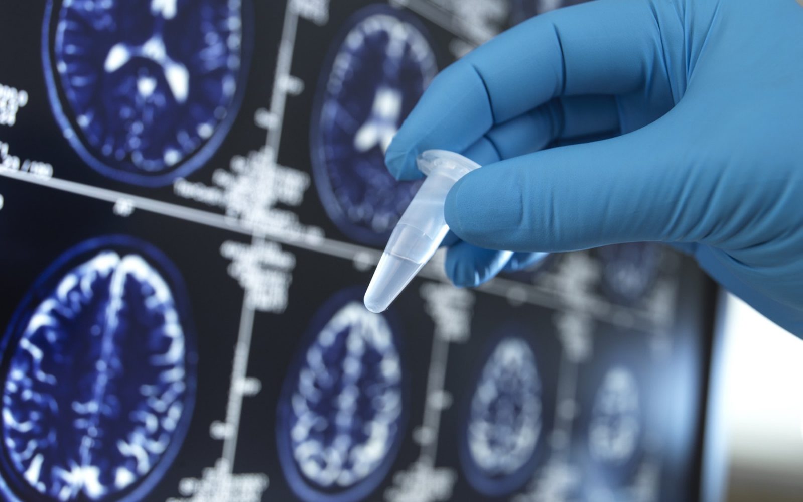 Fotografija prikazuje roko v modrih medicinskih rokavicah, ki drži majhno plastično epruveto. V ozadju so na zaslonu prikazane slike možganov, verjetno MRI posnetki, ki so uporabljeni za medicinsko analizo. Slike možganov imajo oznake in meritve, kar kaže na uporabo tehničnih in diagnostičnih postopkov za pregledovanje možganske aktivnosti ali strukture.