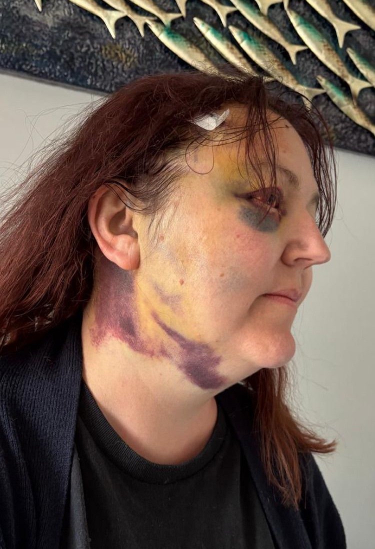 Sarah Hitchman, 43-letna učiteljica, ki je simptome možganskega tumorja sprva pripisovala perimenopavzi.