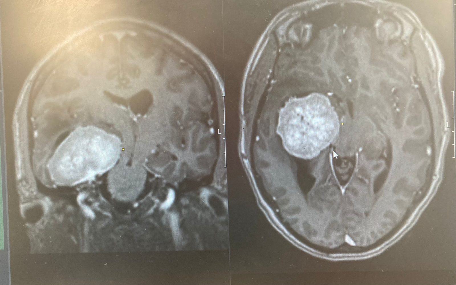 Sarah Hitchman, 43-letna učiteljica, ki je simptome možganskega tumorja sprva pripisovala perimenopavzi.