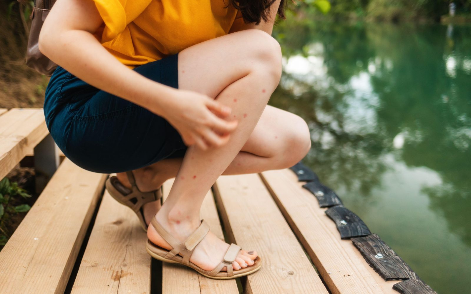 Ženska čepi ob reku in se praska po popikanih nogah, polnih izpuščajev od komarjev.