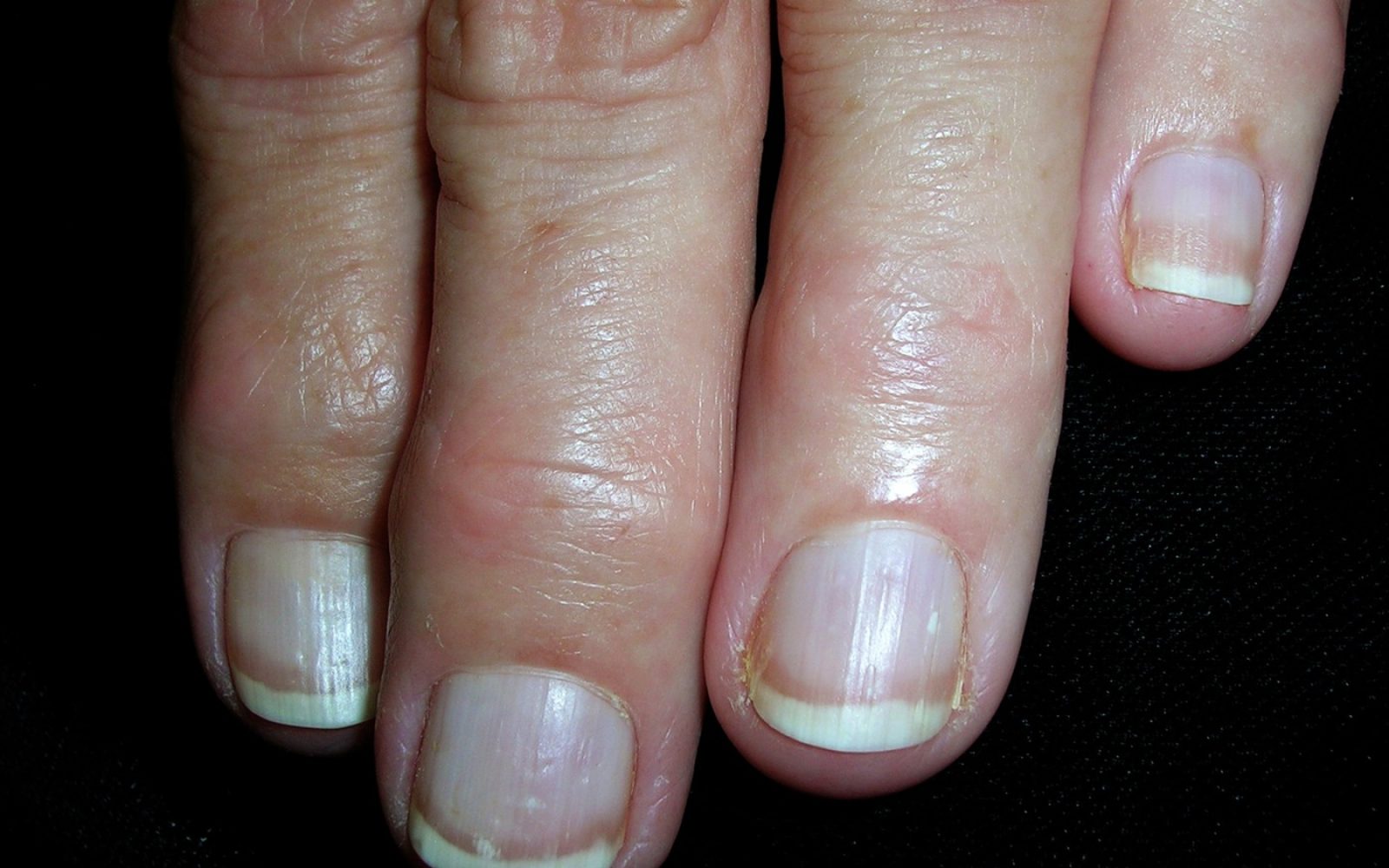 Fotografija prikazuje bližnji posnetek prstov z značilnimi Terryjevimi nohti, kjer je večina nohtne plošče bela, le rob ob konici ostane obarvan.