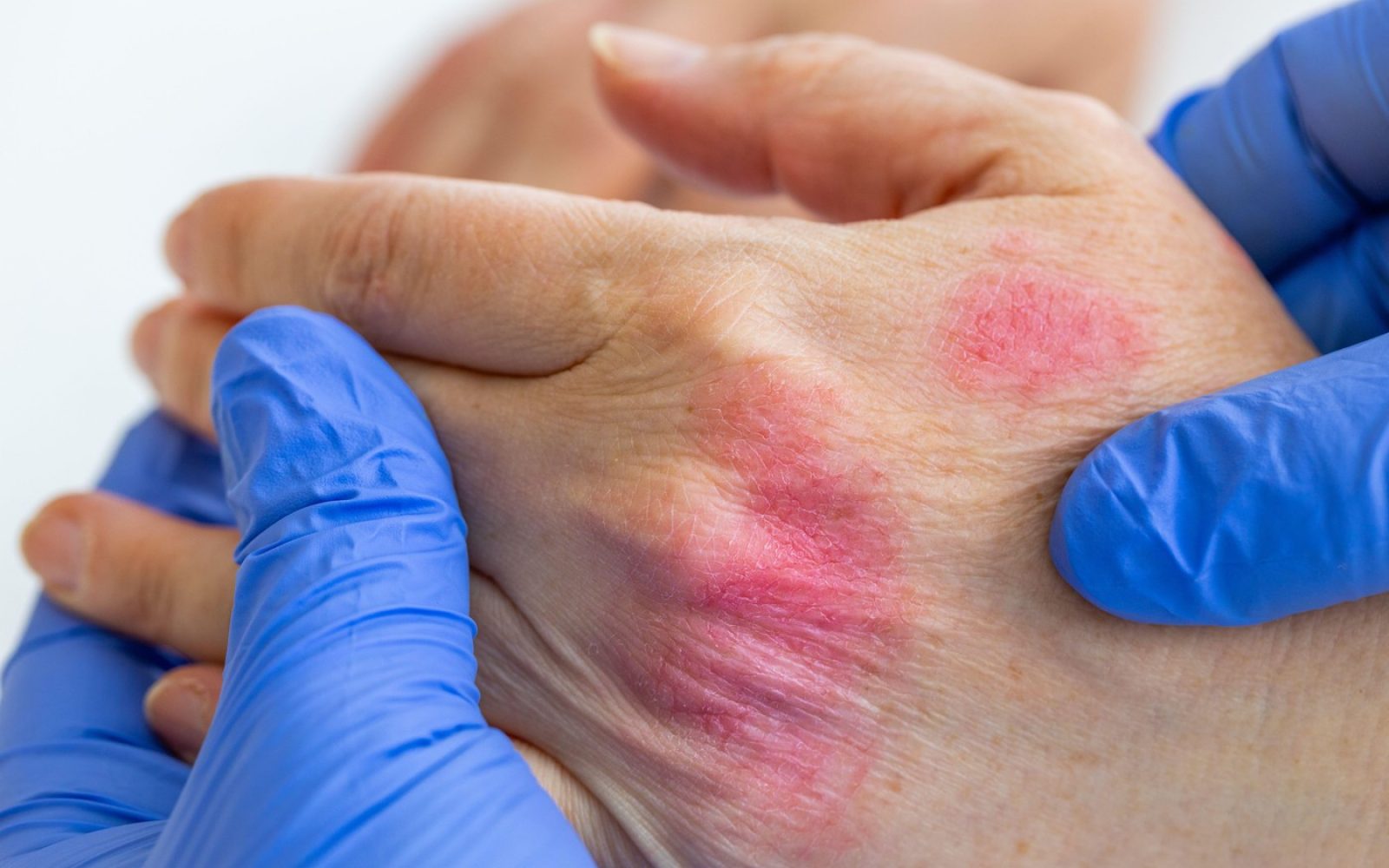 Kožni izpuščaj in rdečica na roki zaradi alergije na pralni prašek