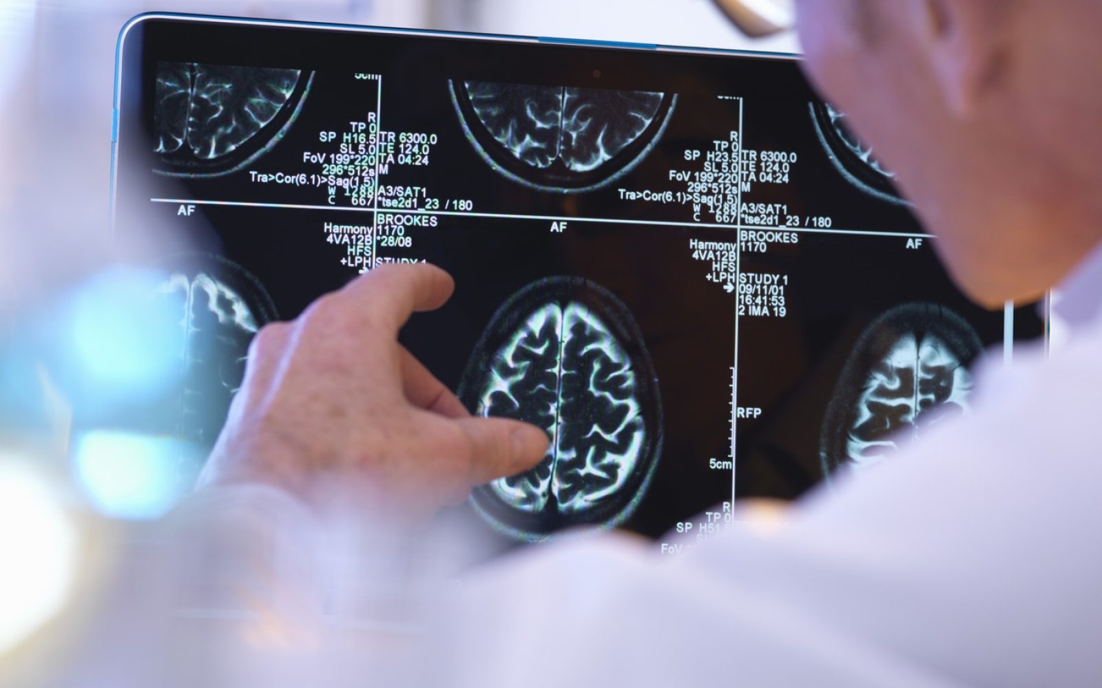 MRI posnetek možganov pri bolniku z multiplo sklerozo – zgodnji znaki MS in diagnoza