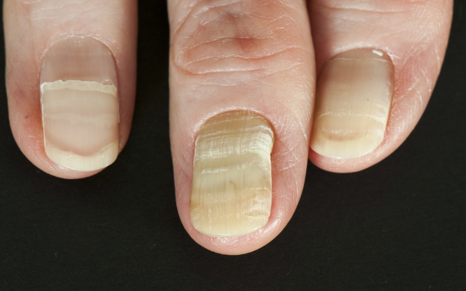 Rumeni nohti so najpogosteje povezani z glivično okužbo (onihomikozo), pri kateri se nohti zadebelijo, obarvajo in drobijo. V redkih primerih so lahko znak resnejših zdravstvenih težav, kot so hude bolezni ščitnice, pljučne bolezni, sladkorna bolezen ali luskavica. Za postavitev diagnoze in ustrezno zdravljenje je potreben zdravniški pregled.