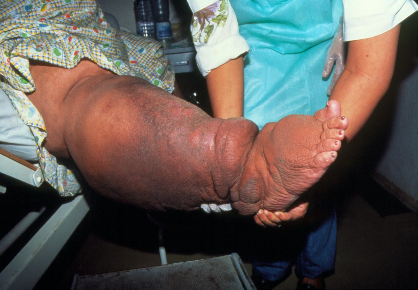 Na fotografiji: značilna huda oteklina noge pri bolniku z elefantiazo (limfatično filariazo). 