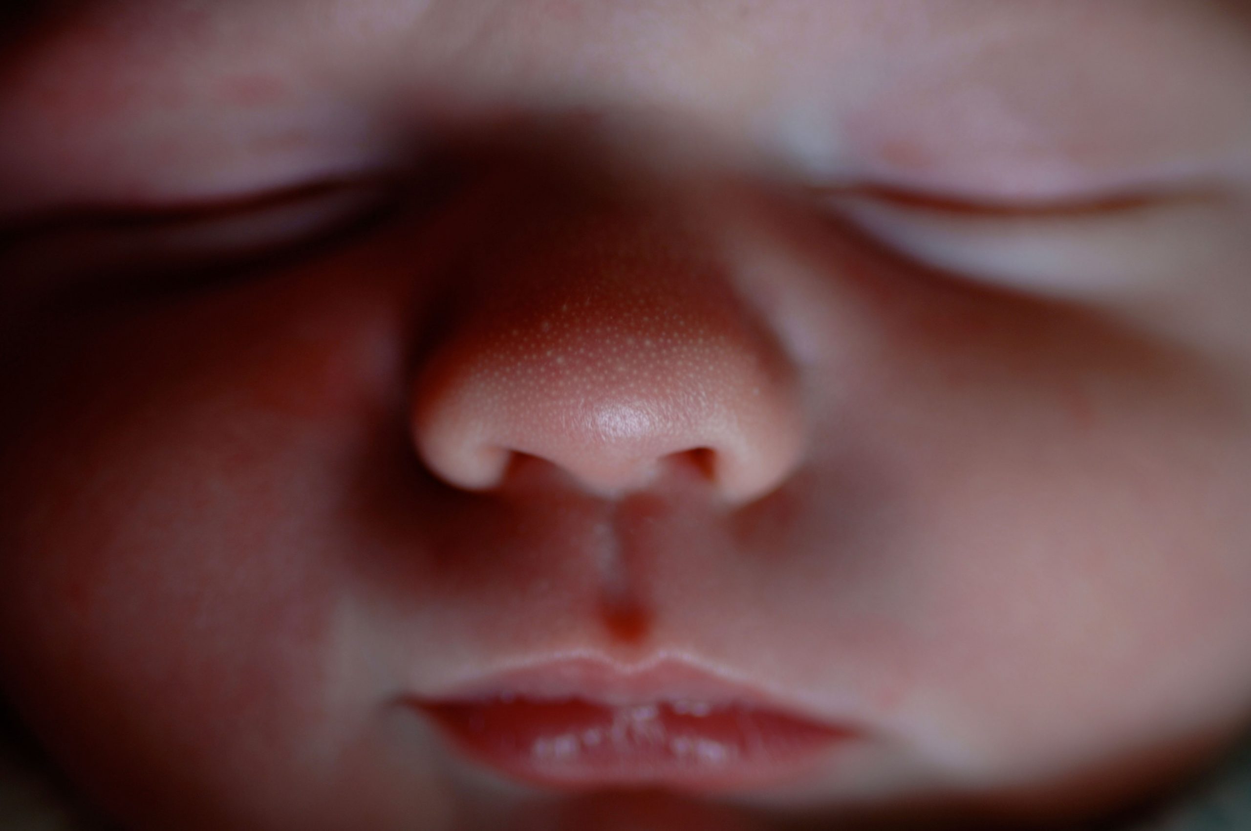 Milija, bela, trda in neboleča cista na dojenčkovem nosu.