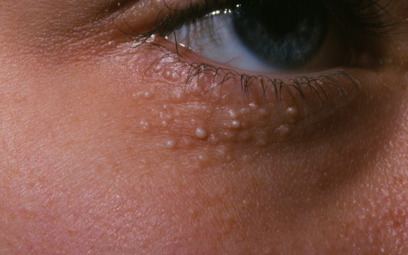 Milije, majhne, bele, trde ciste, pod očesom, ki se pogosto pojavijo po poškodbi kože