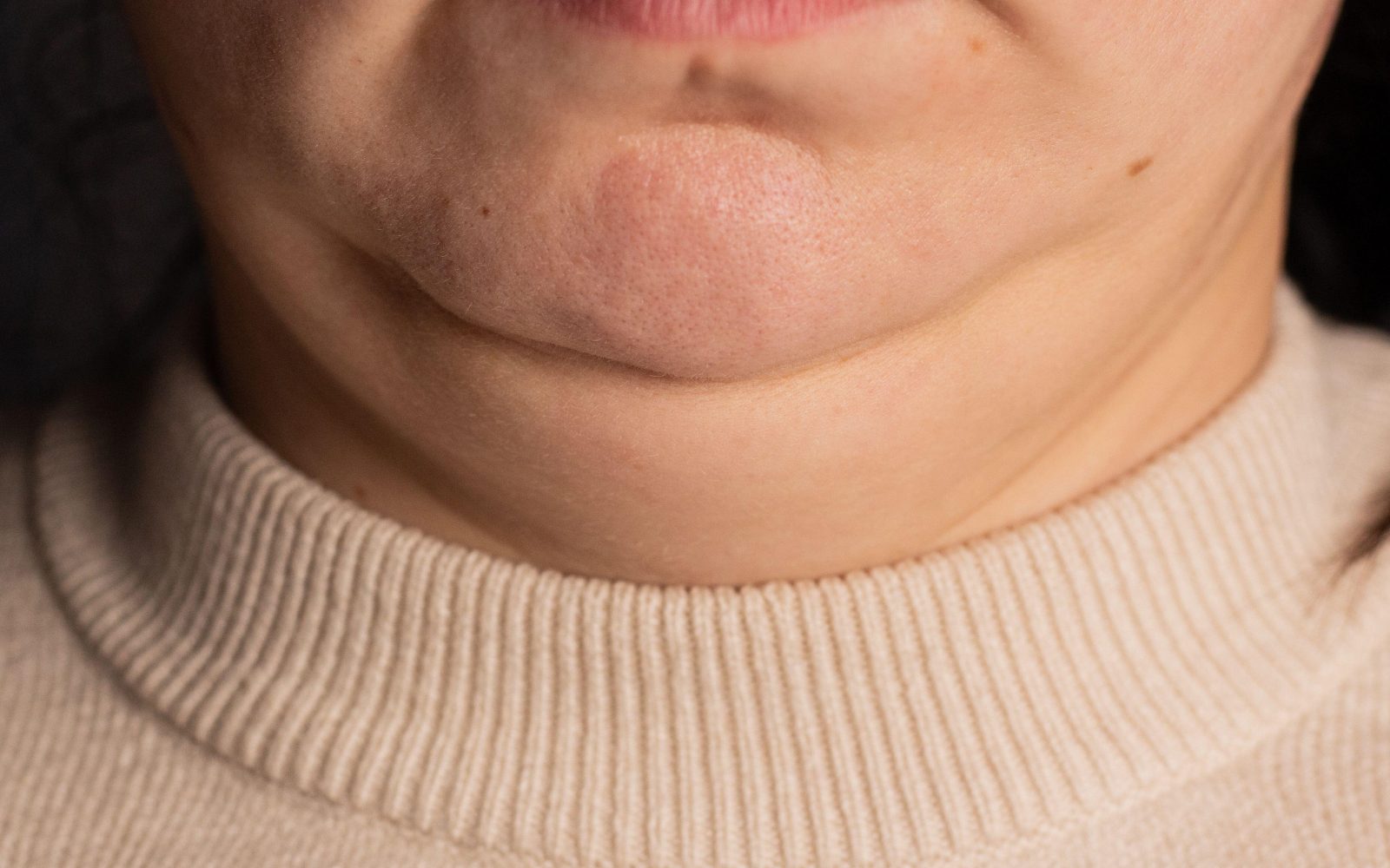 Približana slika ženske z debelim vratom - znak marsikatere zdravstvene težave.