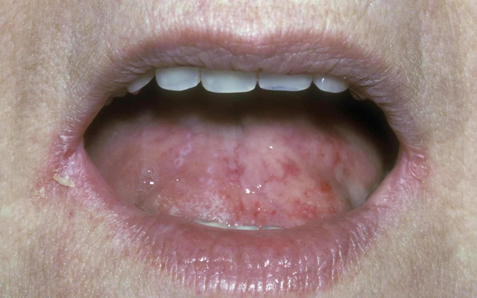 Razpoke v kotičku ust in otekel, gladek jezik – znaki pomanjkanja vitaminov in mineralov.