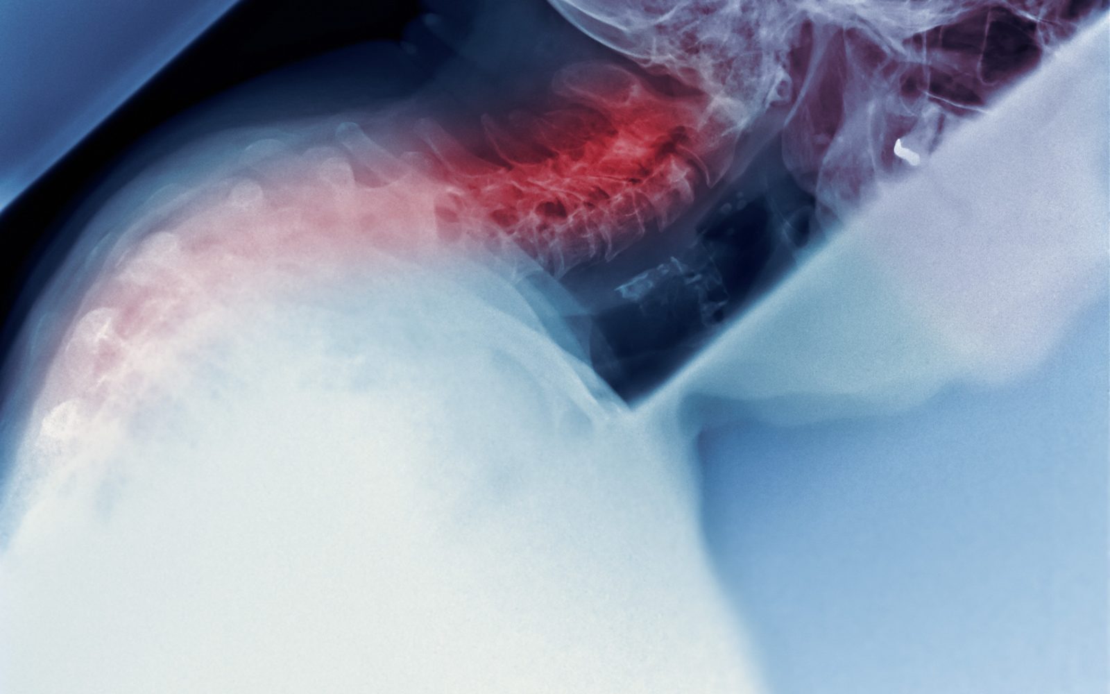 Rentgenski posnetek ukrivljene hrbtenice ženske s kifozo, ki povzroča grbo na vratu.