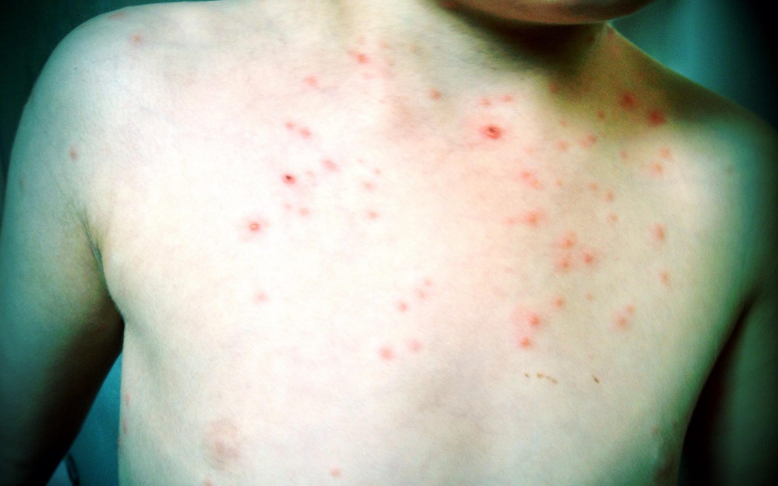 Izpuščaji pri otroku, značilni za norice, z rdečimi mehurčki po prsnem košu
