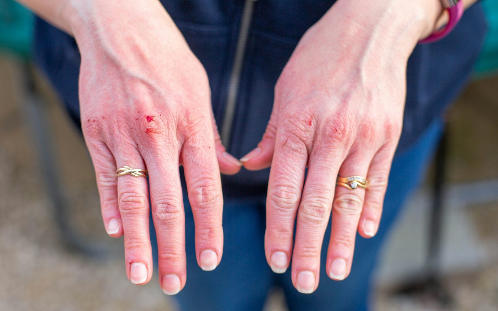 Suha, razpokana in krvaveča koža na rokah