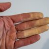 Roka z belimi prsti - Raynaudov sindrom