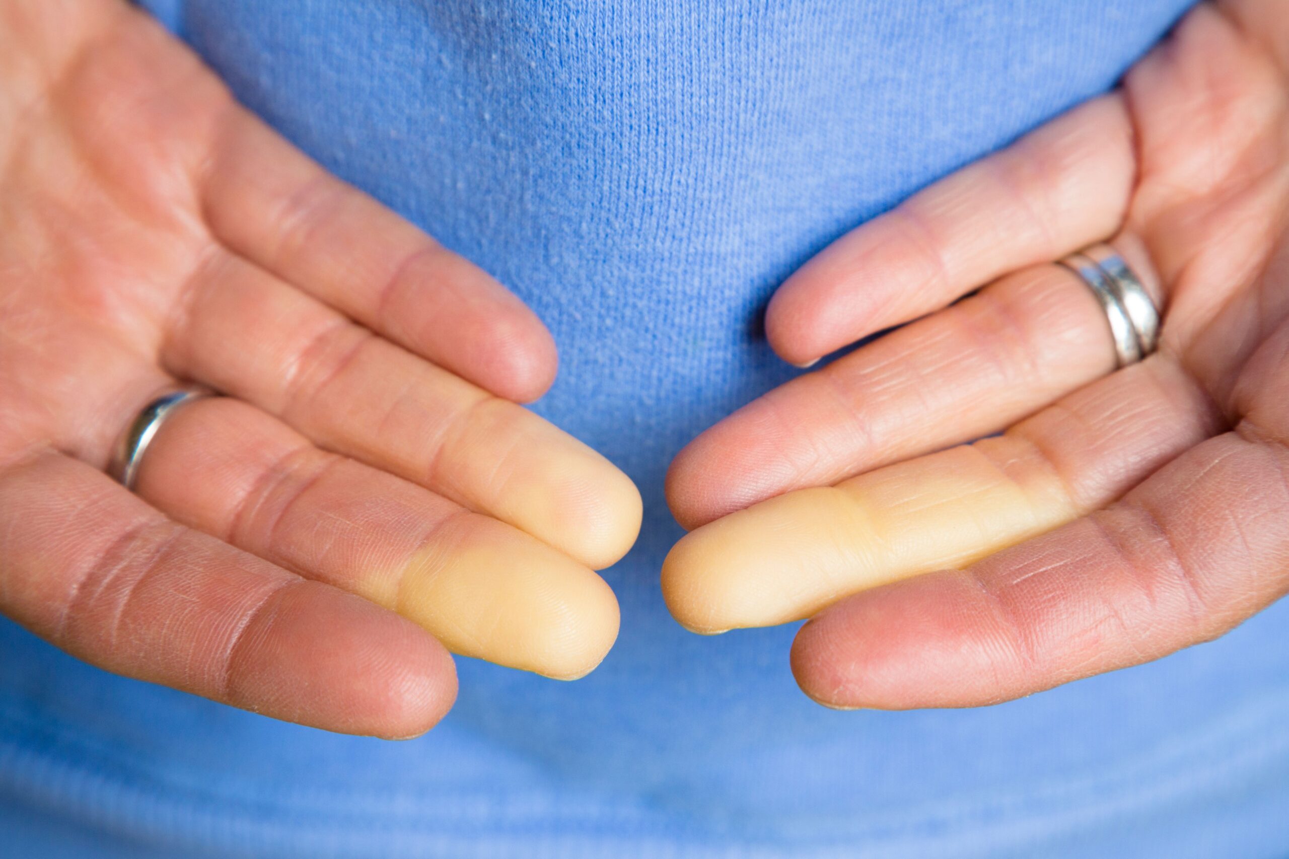 Prsti ženske z Raynaudovim sindromom pri katerem mraz zmanjša pretok krvi v prste.