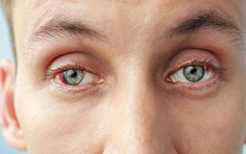 Rdeče oči zjutraj