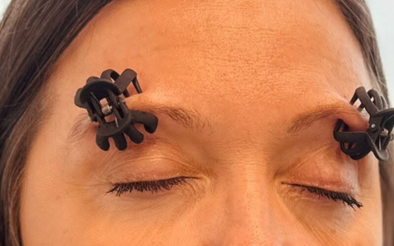 Ali sponka na obrveh res ublaži migreno? To pravijo zdravniki