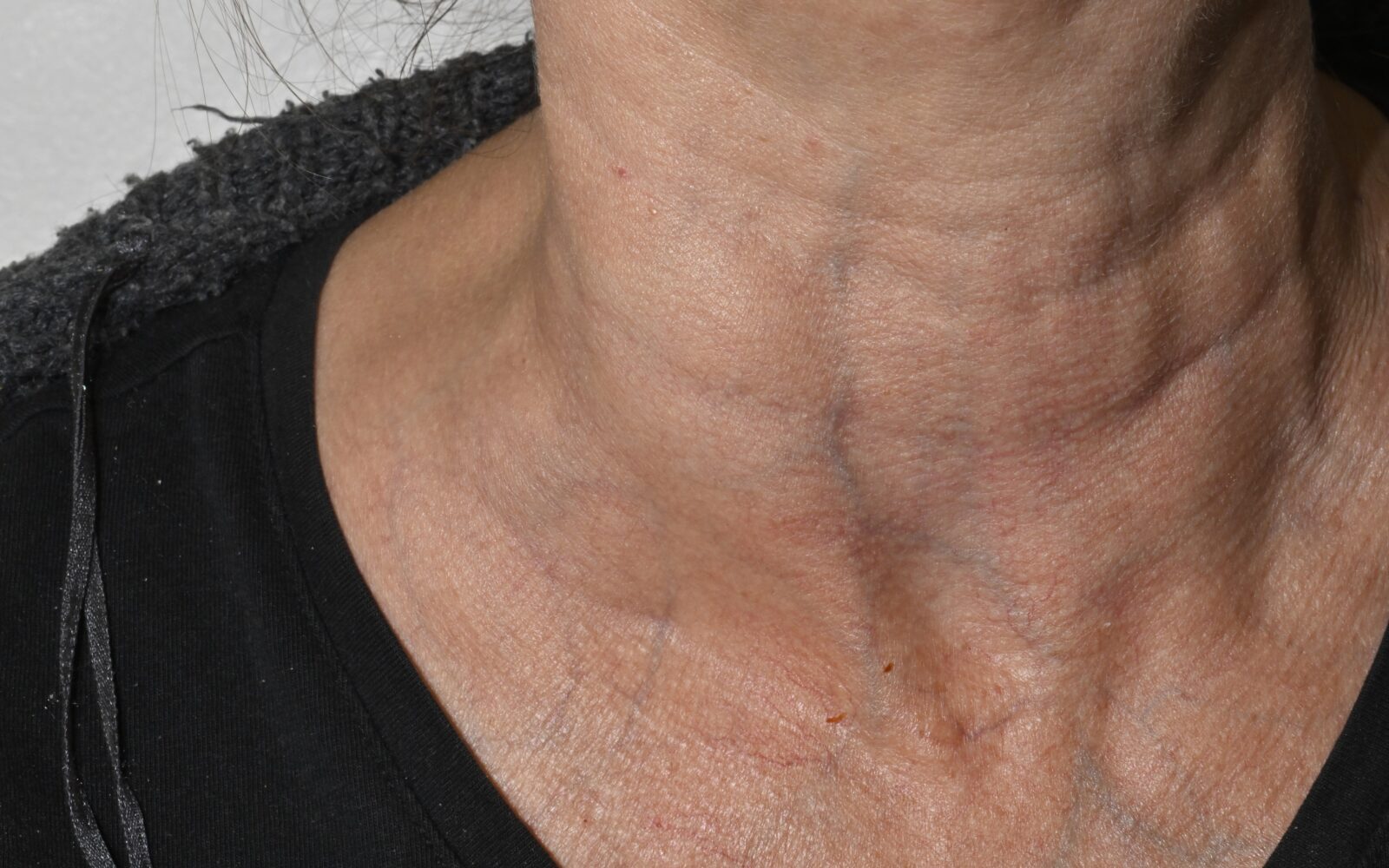 Vrat ženske, na kateri se vidi otečena bezgavka - simptom limfoma