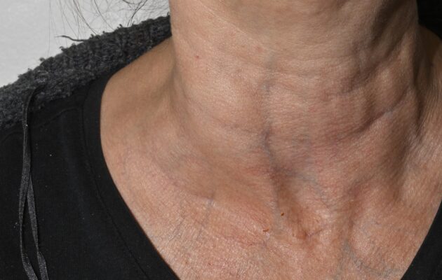 Vrat ženske, na kateri se vidi otečena bezgavka - simptom limfoma