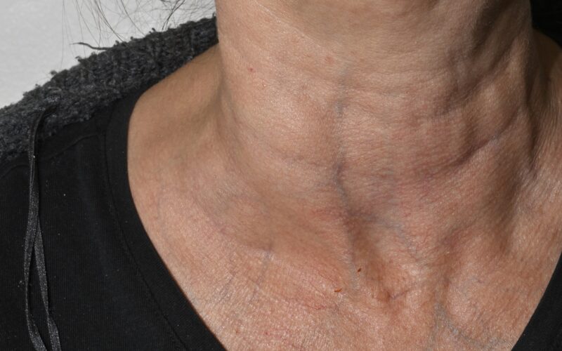 Vrat ženske, na kateri se vidi otečena bezgavka - simptom limfoma