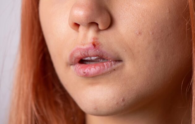 bližnji posnetek ženskega obraza z labialnim hepesom