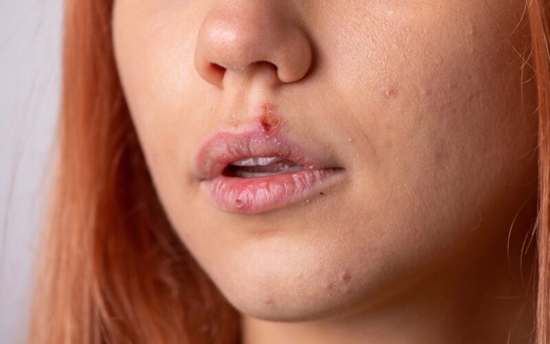 Herpes na ustnici: kako se prenaša, kako ga zdraviti in kdaj k zdravniku?