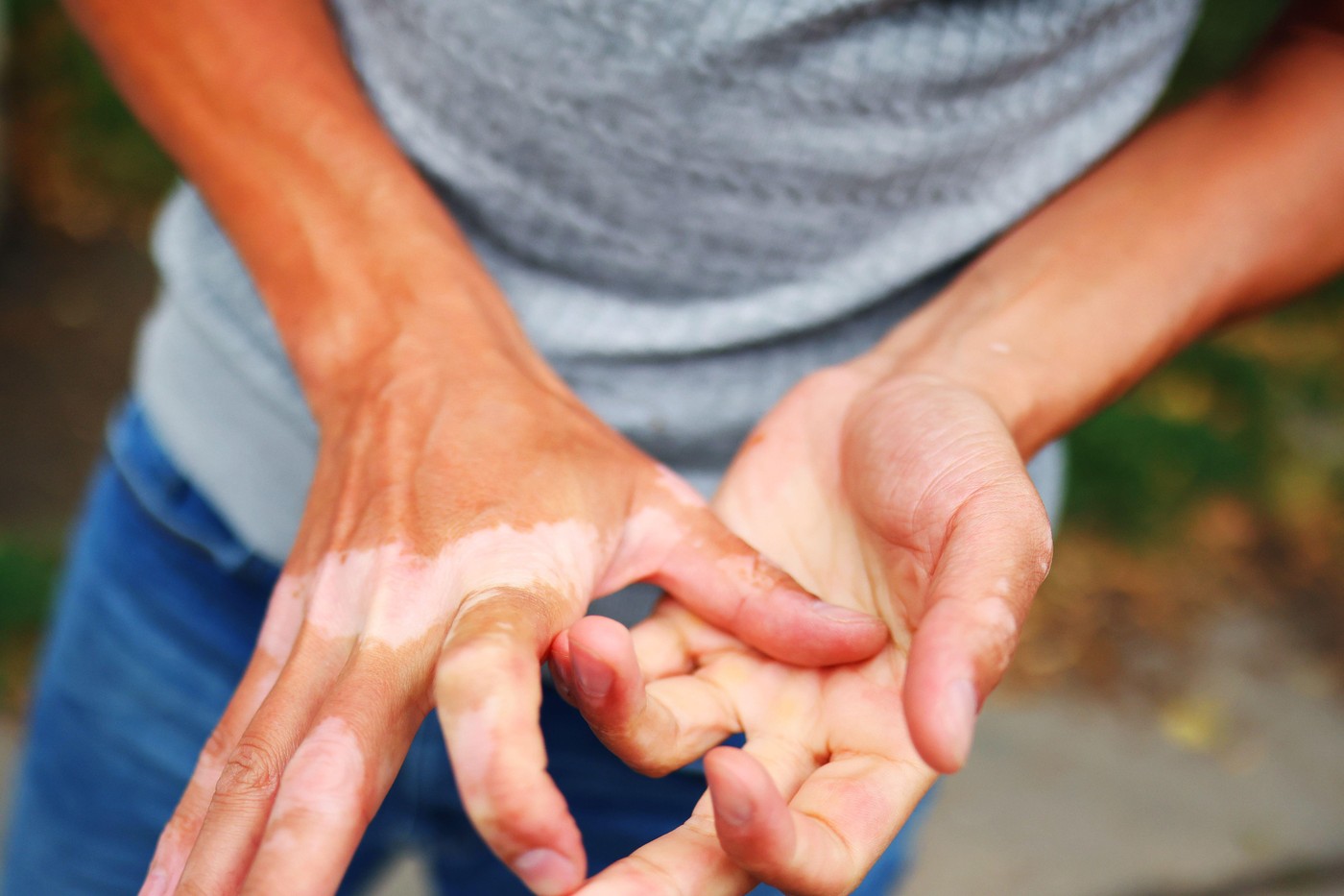Vitiligo na rokah - akrofacialna oblika z depigmentiranimi lisami na prstih in dlaneh
