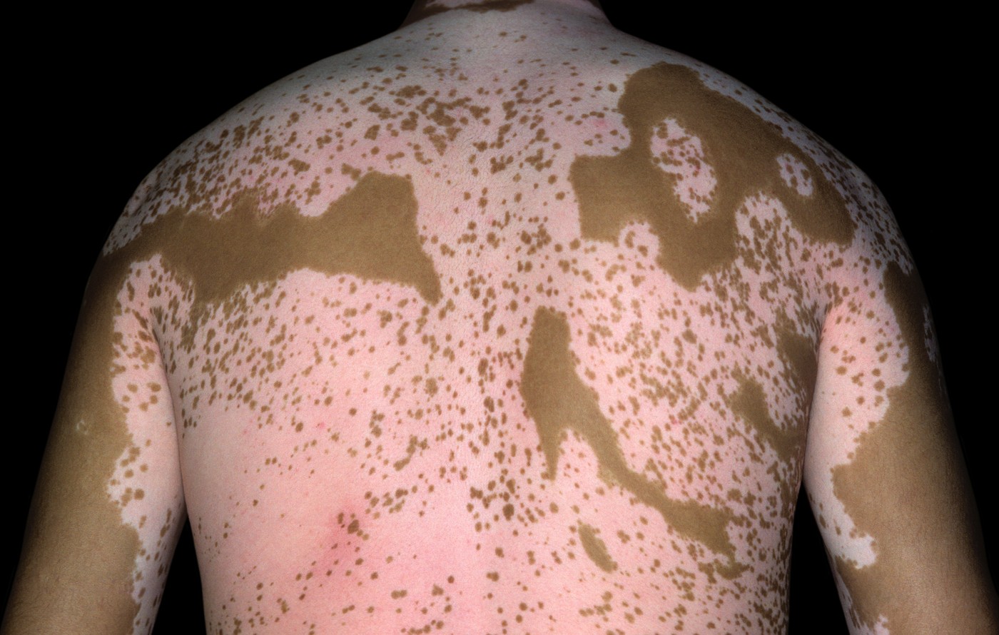 Vitiligo na hrbtu - generalizirana oblika z večjimi depigmentiranimi lisami